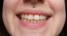 Bělení zubů - před