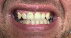 Bělení zubů - před