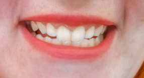 Bělení zubů - po