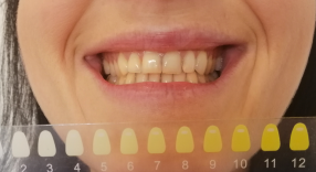 Bělení zubů před